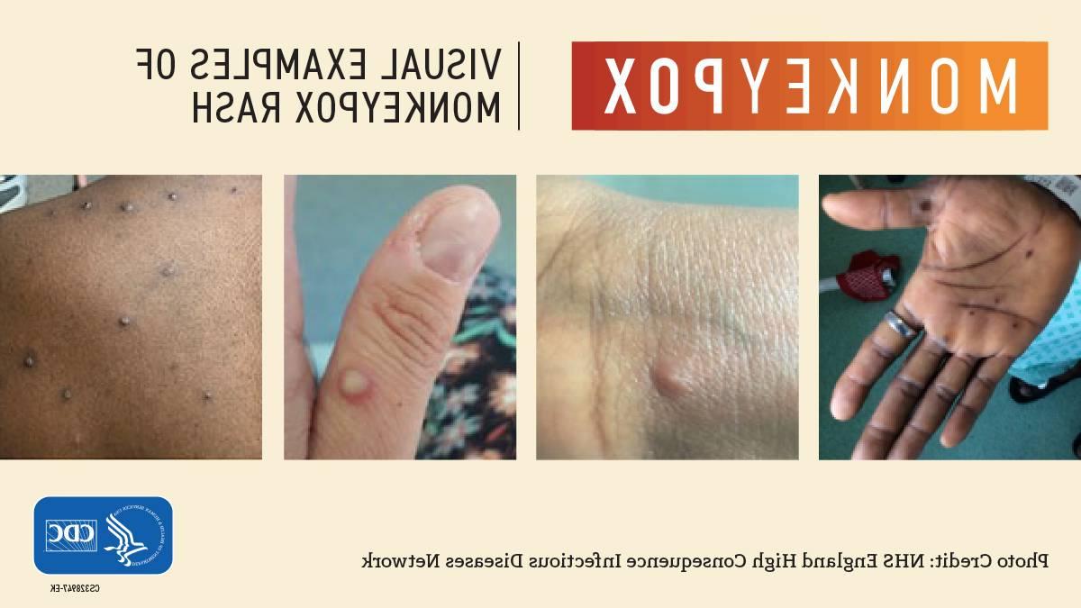 Visual Examples of Monkeypox